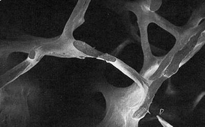 Osteoporosis bone